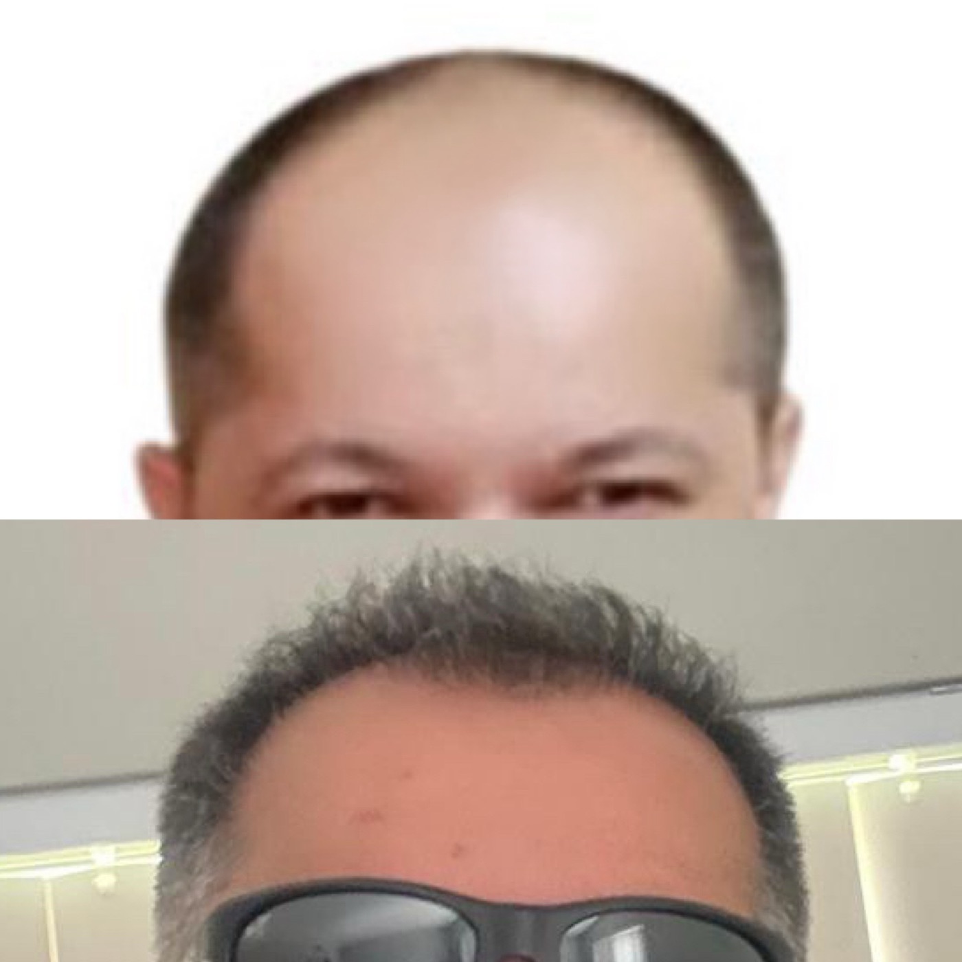 Hair restoration case