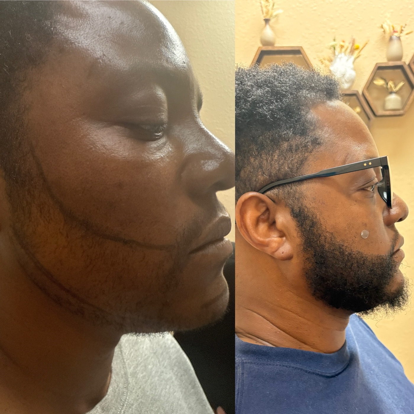 Hair restoration case