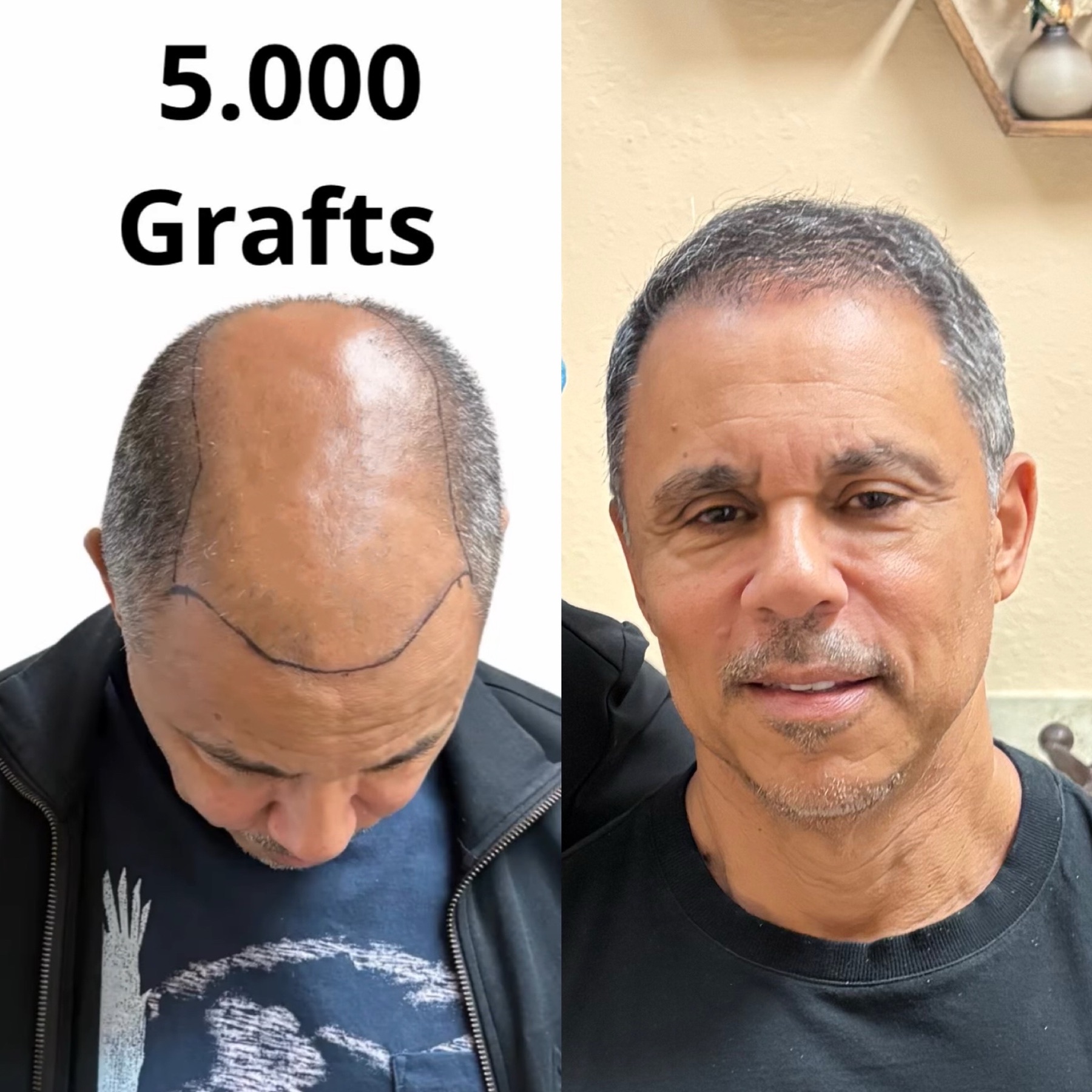 Hairline 5,000 grafts