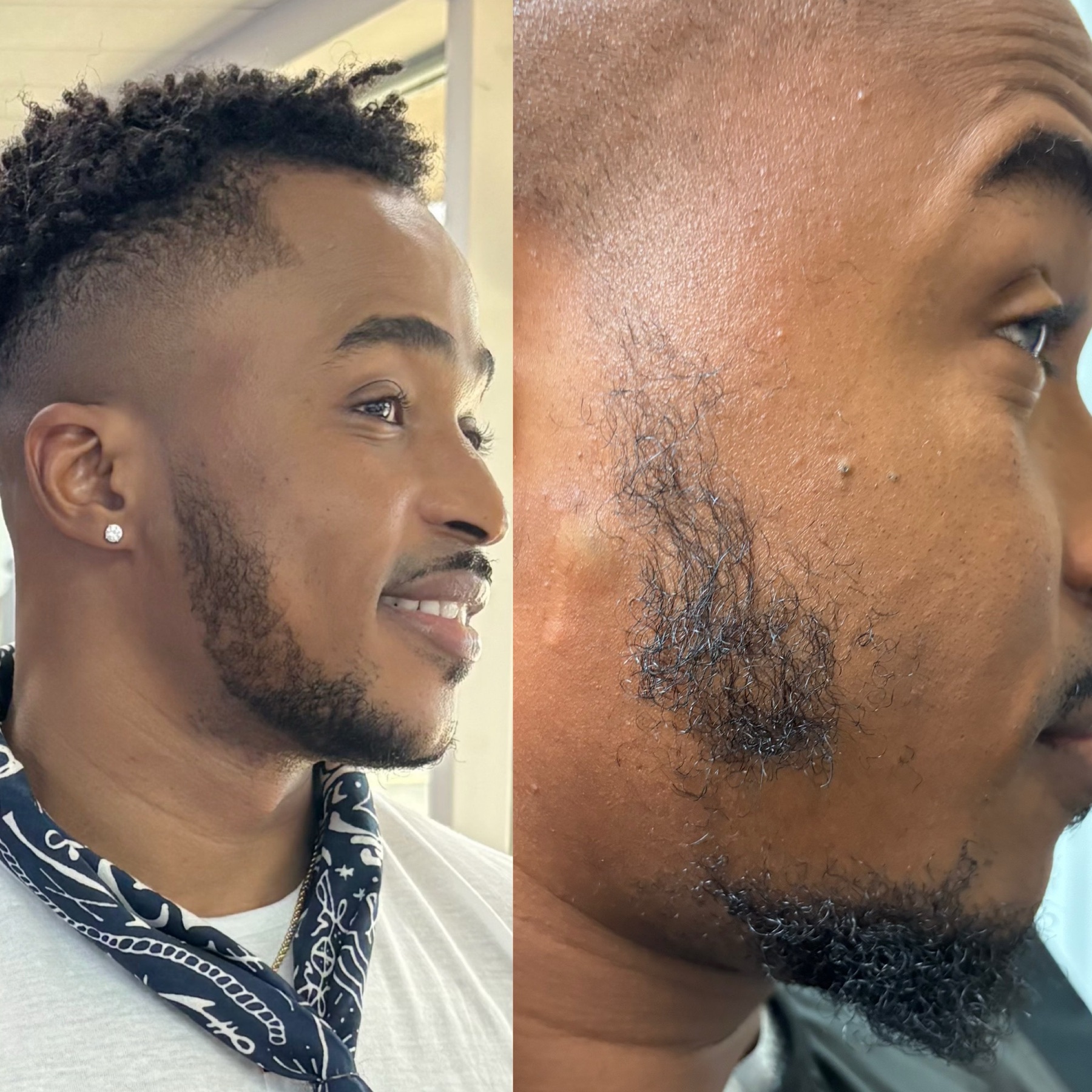 Beard restoration