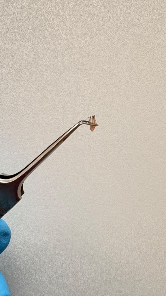 A single graft held in forceps, follicles clearly visible