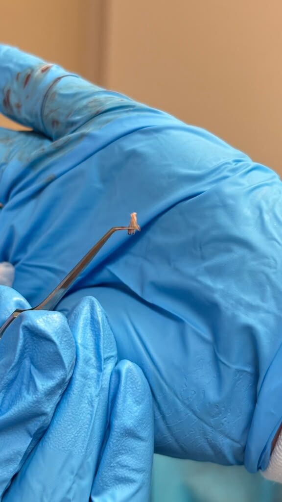 A healthy graft handled with care during the procedure