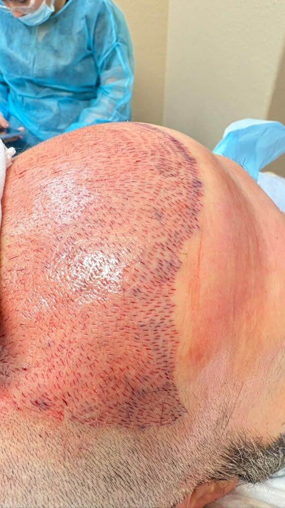 Detail of the incision pattern made during a Micro-FUE procedure
